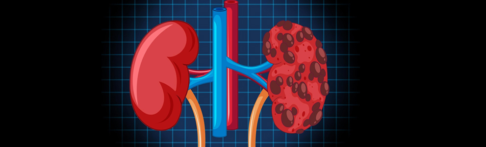 Anaemia in Chronic Kidney Disease: Causes and Treatment